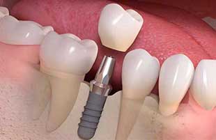 CONVENTIONAL IMPLANTS